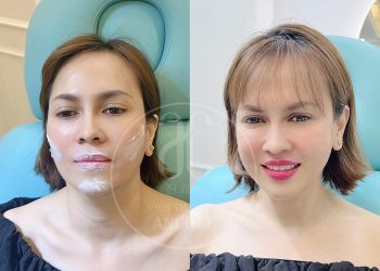 Tiêm Hạ Gò Má Là Gì? Giữ Được Bao Lâu? Giá Bao Nhiêu?