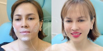 Tiêm Hạ Gò Má Là Gì? Giữ Được Bao Lâu? Giá Bao Nhiêu?