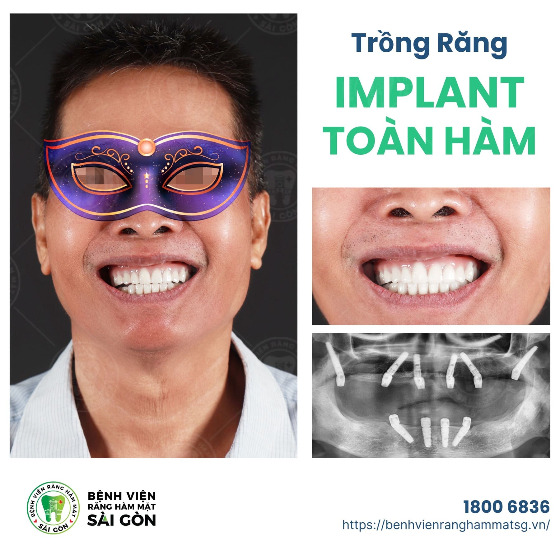 trồng răng sứ cố định và bán cố định