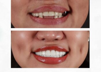 trồng răng sứ cố định và bán cố định
