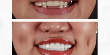 trồng răng sứ cố định và bán cố định