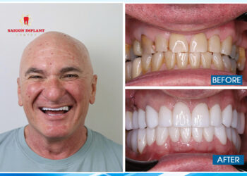 What to Expect from Cosmetic Dentistry Vietnam