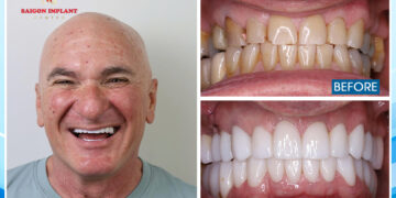 What to Expect from Cosmetic Dentistry Vietnam
